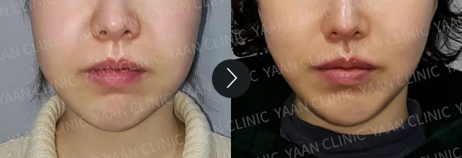 Before and after 1 month: Ultherapy Prime - case 3