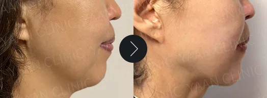 Before and after: Silhouette Soft thread lifting on the face - case 6