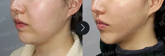 Before and after: Ultherapy Prime on the face and jawline - case 8
