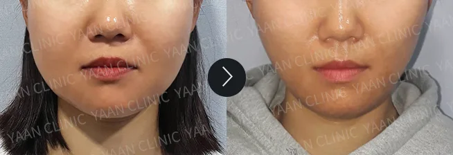 Before and after 1 month: Ultherapy Prime - case 2