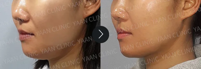 Before and after 9 years: Ultherapy Prime - case 9