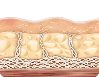 คอลลาเจนลดลง → ผิวหย่อนคล้อย - Ultherapy Prime