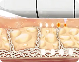 การรักษาด้วย Ultherapy Prime ที่ Yaan Clinic ย่านคังนัม กรุงโซล