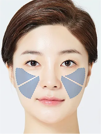 Sunken front cheeks and deep nasolabial folds (Yaan Clinic, Gangnam)