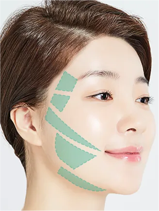 Side cheeks, sagging jowls, and double-chin line (Yaan Clinic, Gangnam)