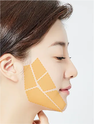 Sagging jawline caused by loss of elasticity (Yaan Clinic, Gangnam)