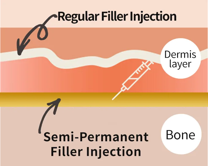 ความแตกต่างตามชั้นที่ฉีด - ฟิลเลอร์ Artecoll ที่ Yaan Clinic ย่านกังนัม กรุงโซล