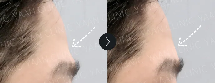 Artecoll filler before and after, Under-eye, case 1 — Before & After (Yaan Clinic, Gangnam)