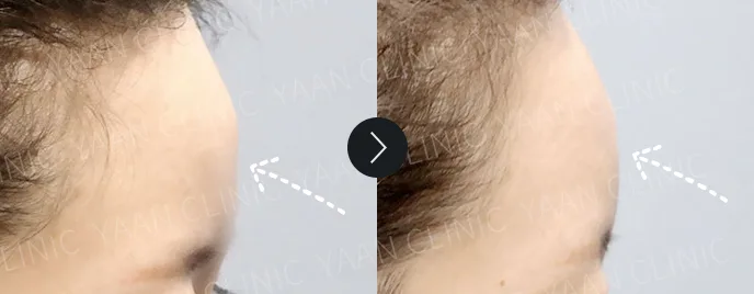 Artecoll filler before and after, Forehead, case 2 — Before & After (Yaan Clinic, Gangnam)