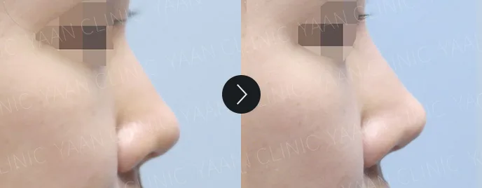 Artecoll filler before and after, Nose, case 1 — Before & After (Yaan Clinic, Gangnam)