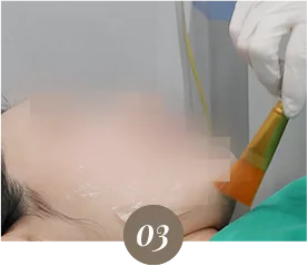 ขั้นตอนการทำ Dual Titanium Lifting ที่ Yaan Clinic ย่านกังนัม กรุงโซล