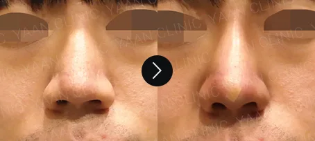Nose Filler and Thread before and after, case 1 — Before / Immediately after the procedure (Yaan Clinic, Gangnam)