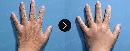 Before and after 1 month: hand wrinkle filler - case 1