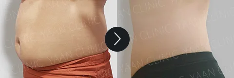 Before and after 3 months: Di-Fat fat reduction treatment - case 1