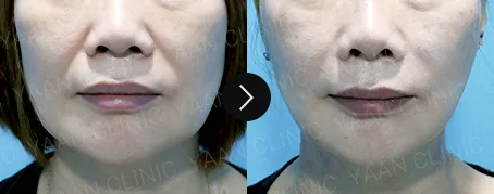 Before and after 1 month: Oligio lifting on the face - case 1