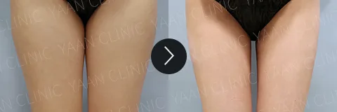 Before and after 3 months: Di-Fat fat reduction treatment - case 10
