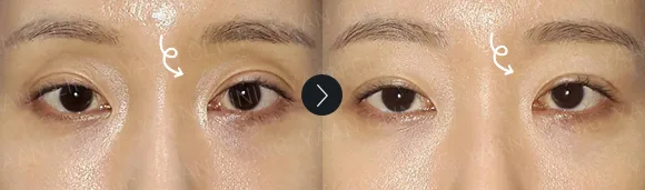 Before and after 2 months: under-eye and eyelid filler - case 1