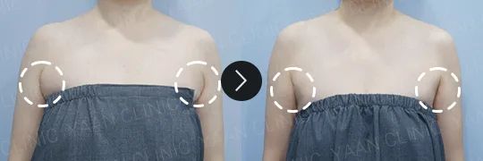 Before and after 3 months: Ulfit on the body - case 1