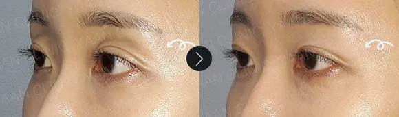 Before and after 2 months: under-eye and eyelid filler - case 5