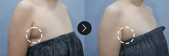 Before and after 3 months: Ulfit on the body - case 2