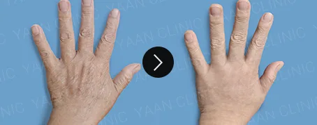 Before and after 1 month: hand wrinkle filler - case 4