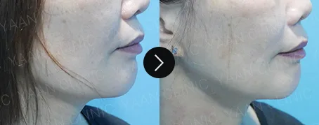 Before and after 1 month: Oligio lifting on the face - case 4