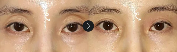 Before and after 2 months: under-eye and eyelid filler - case 2