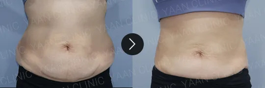 Before and after 3 months: Ulfit on the body - case 3