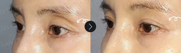 Before and after 2 months: under-eye and eyelid filler - case 6