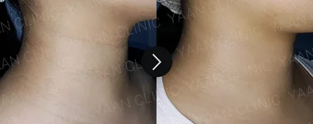 Before and after 2 months: neck line filler on the neck - case 6
