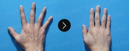 Before and after 1 month: hand wrinkle filler - case 5