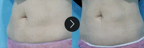 Before and after 3 months: Di-Fat fat reduction treatment - case 3