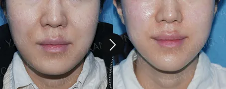 Before and after 1 month: Oligio lifting on the face - case 2