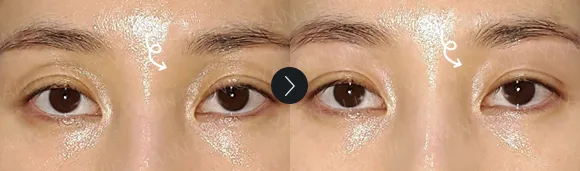 Before and after 2 months: under-eye and eyelid filler - case 3