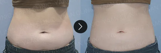 Before and after 3 months: Ulfit on the body - case 4