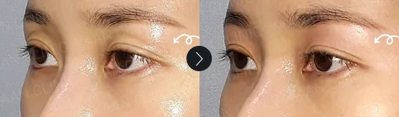 Before and after 2 months: under-eye and eyelid filler - case 7