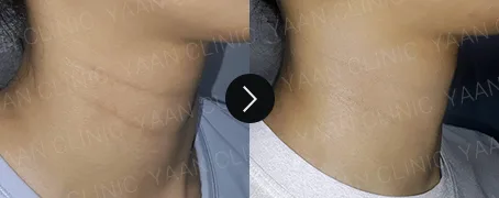 Before and after 2 months: neck line filler on the neck - case 7