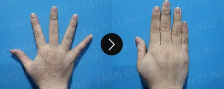 Before and after 1 month: hand wrinkle filler - case 2