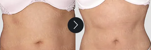 Before and after 3 months: Di-Fat fat reduction treatment - case 4
