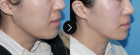 Before and after 1 month: Oligio lifting on the face - case 5