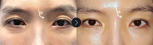 Before and after 2 months: under-eye and eyelid filler - case 4