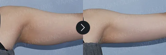 Before and after 3 months: Ulfit on the body - case 5