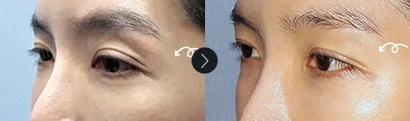 Before and after 2 months: under-eye and eyelid filler - case 8