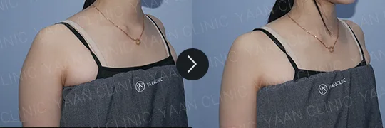 Before and after 3 months: Ulfit on the body - case 8