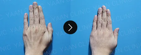 Before and after 1 month: hand wrinkle filler - case 6