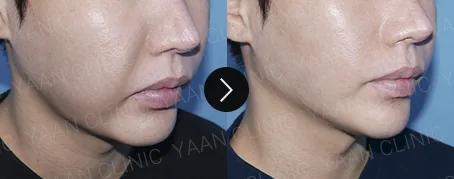 Before and after 1 month: Oligio lifting on the face - case 3