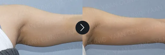 Before and after 3 months: Ulfit on the body - case 6
