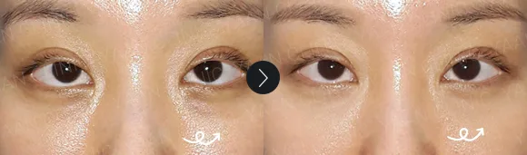 Before and after 2 months: under-eye and eyelid filler - case 9