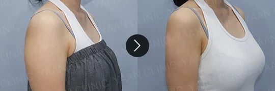 Before and after 3 months: Ulfit on the body - case 9