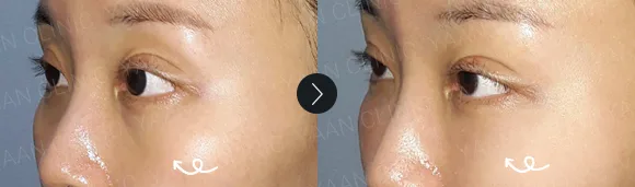 Before and after 2 months: under-eye and eyelid filler - case 13
